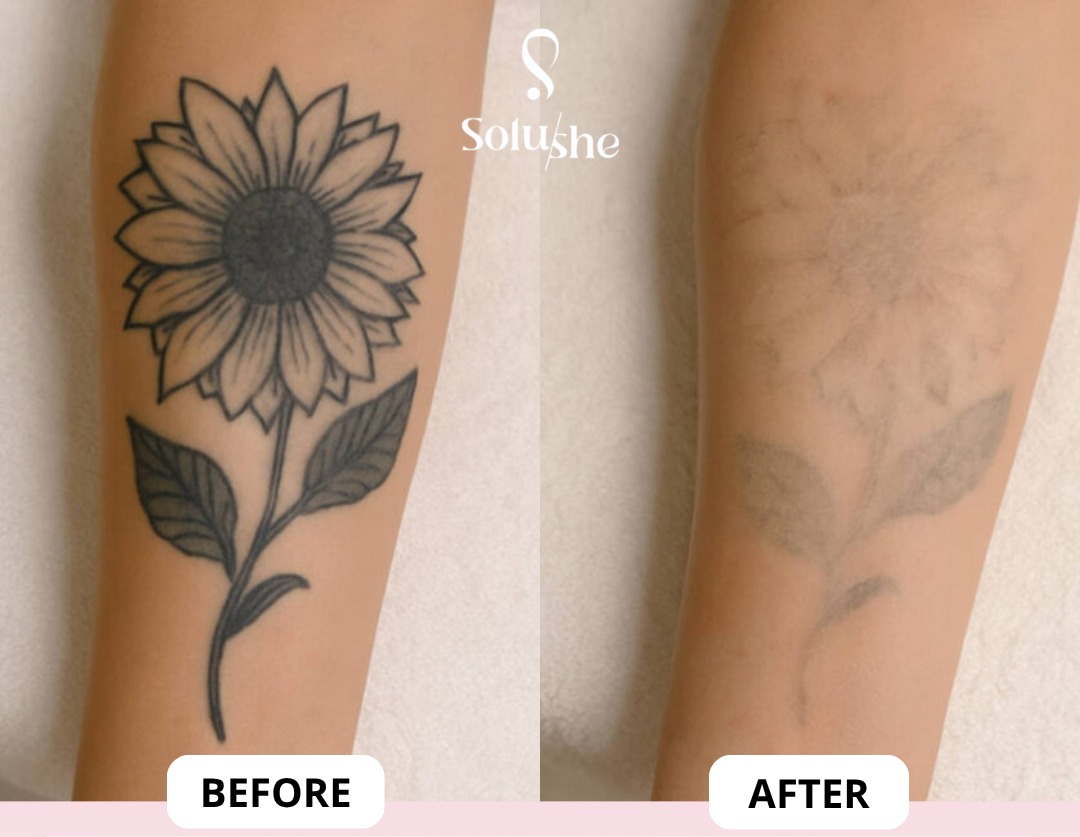 Hasil nyata before after Laser Tattoo Solushe