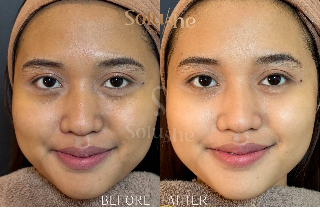 Hasil nyata before after Whitening Facial Solushe
