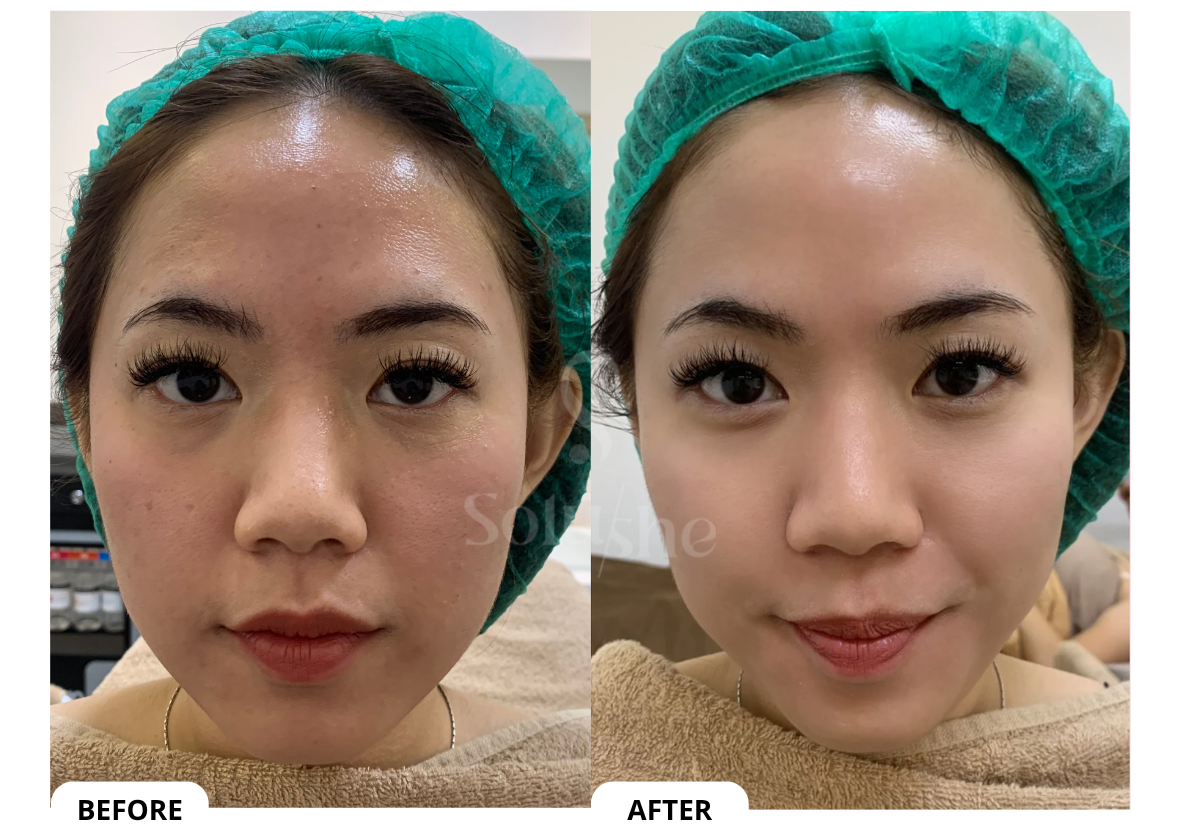 Hasil nyata before after Face Toning Solushe