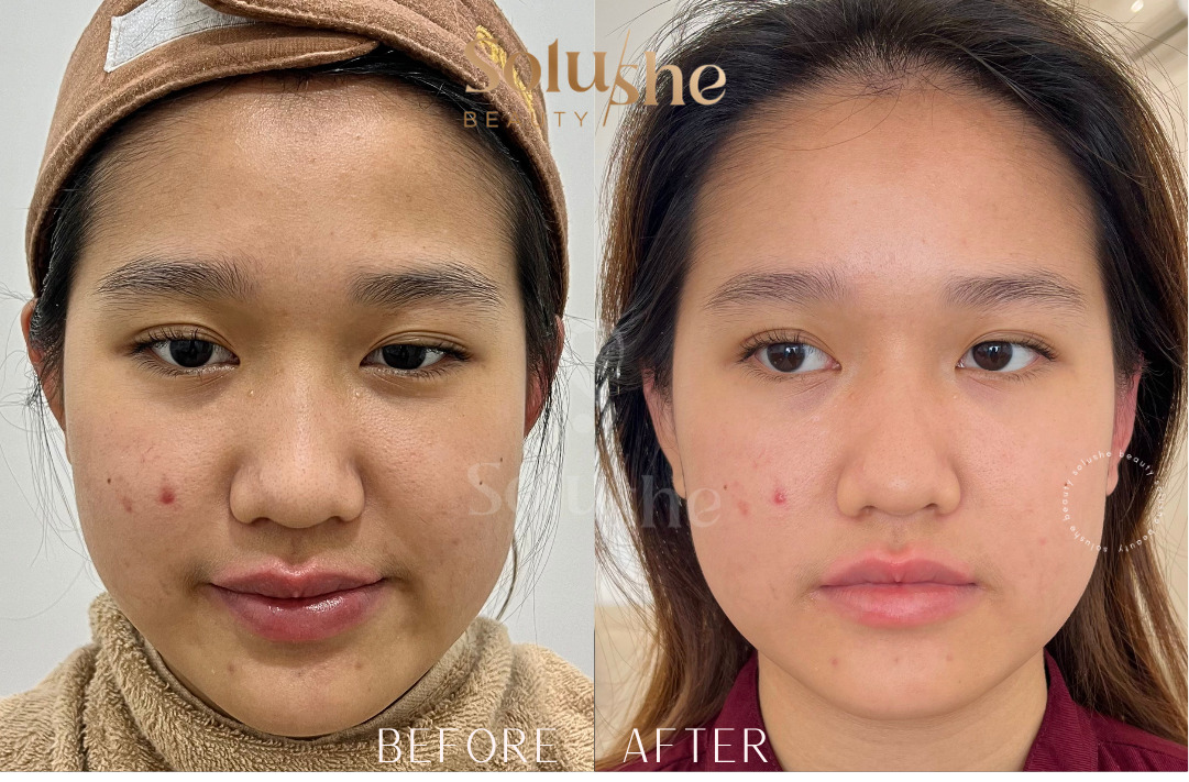 Hasil nyata before after Photofacial Solushe