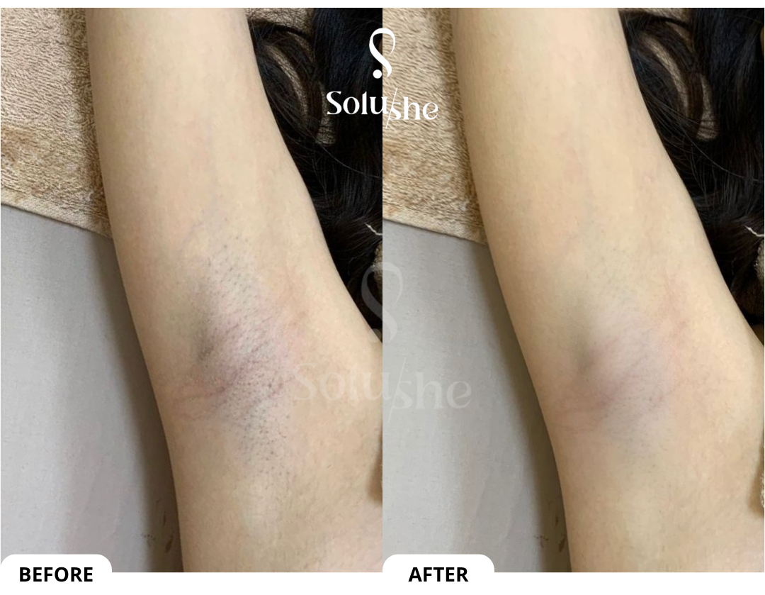 Hasil nyata before after Underarms Hair Removal Solushe