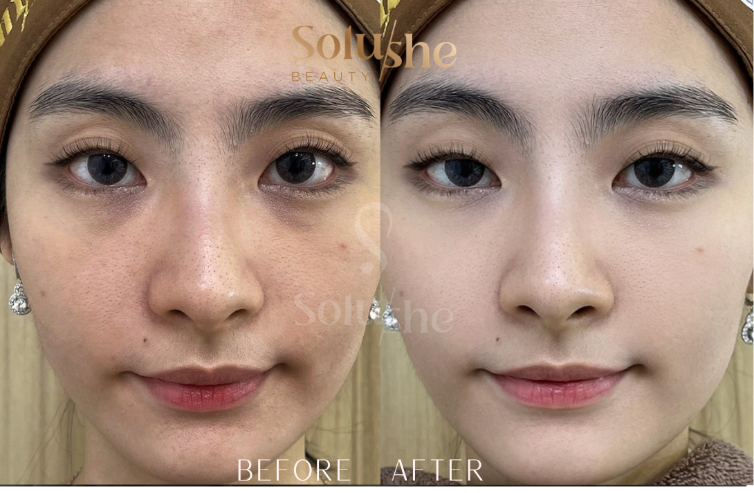Hasil nyata before after Diamond Peel Facial Solushe