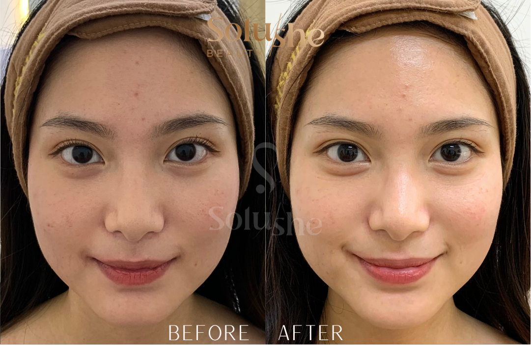 Hasil nyata before after First Class Glow Facial Solushe