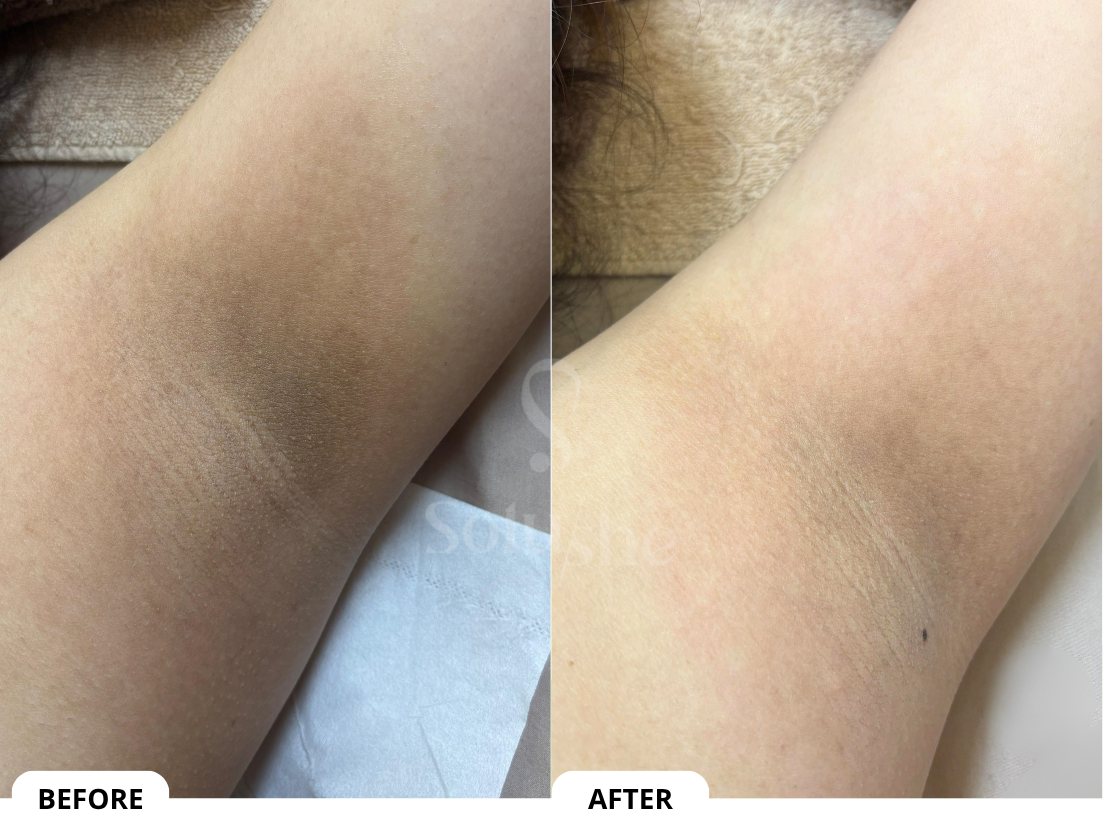 Hasil nyata before after Underarm Toning Solushe